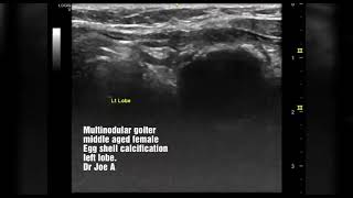 Multinodular goiter thyroid  eggshell calcification ultrasound video [upl. by Wivinia]