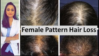 Hair loss in women  Female Pattern Hair Loss  causes amp treatment  Dermatologist [upl. by Rtoip697]