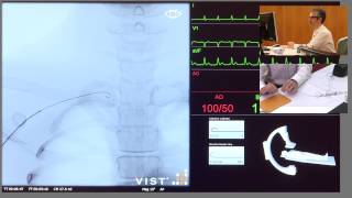 Catheterisation of Left Coronary Artery [upl. by Aihseuqal]