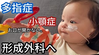 【4pマイナス症候群】多指症と1㎝しか開かないお口をみてもらいました。 [upl. by Cavill442]