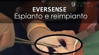 EVERSENSE  Il sensore sottopelle Espianto e reimpianto nello stesso sito [upl. by Felicie467]