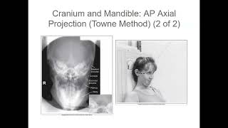 Cranium and Mandible Ap Axial Projection Towne Method [upl. by Dallman907]