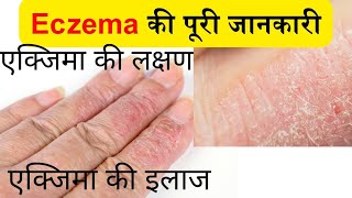 Eczema क्या हैं  Eczema की पूरी जानकारी  eczema kya hota hai  eczema ka ilaj [upl. by Margaret]