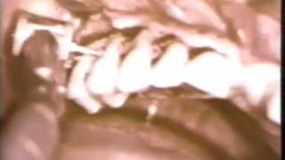 Osseous Surgery in the Maxilla [upl. by Carlock]