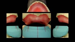 Art of denture 2014 [upl. by Nevyar887]