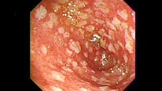 Gastric Intestinal Metaplasia  Chuyển sản ruột [upl. by Eniale]