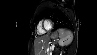 Arrhythmogenic Right Ventricular Cardiomyopathy [upl. by Retsim733]