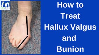 How to Treat Hallux Valgus and Bunion [upl. by Rendrag]