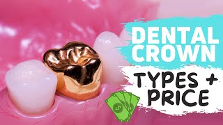 Dental Crowns Explained  WATCH BEFORE YOUR CROWN PROCEDURE [upl. by Htyderem622]