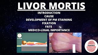 Livor mortis  Cause  Development  Fixation  Fate  Medicolegal importance  Forensic medicine [upl. by Enert]