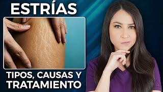 ESTRÍAS l ¿Cuál es el TRATAMIENTO ¿Se pueden prevenir👩🏻‍⚕️ drapauzuniga [upl. by Sven873]