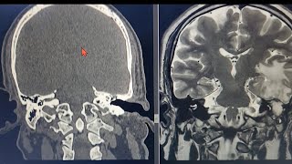 Ear Infection 👂 Leading into BRAIN infection 🧠 Radiology ent skull neurosurgeon [upl. by Socem]