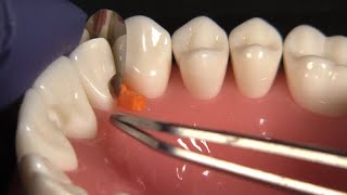 Tips for Using the NEW Fusion Anterior Matrix System for Deep Restorations with Dr JD Corey [upl. by Wivestad]