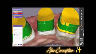 Easy way to make the gingival reduction design guide in Exocad 🦷exocad design cfao cao dental [upl. by Emelen]