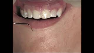 Demo C24 Esthetic Crown Lengthening By Apically Positioned Flap [upl. by Learsiy]