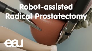 Robotassisted Radical Prostatectomy RARP [upl. by Enalb943]