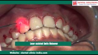 Laser Cosmetic Surgery Bangalore  Smile Makeover Treatment India [upl. by Verlee702]