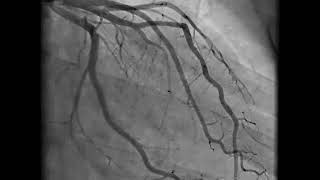 Coronary Angiography  NEJM [upl. by Lamiv]