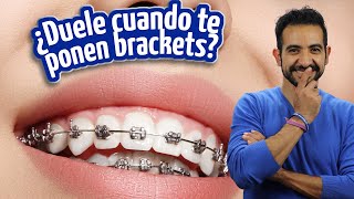 ¿Duele cuando te ponen Brackets [upl. by Sandell622]