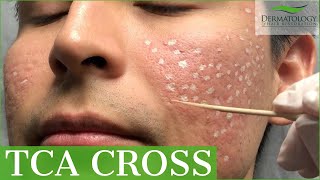 Acne Scar Removal with TCA Cross 80  Los Angeles  Dr Ben Behnam [upl. by Thorin]