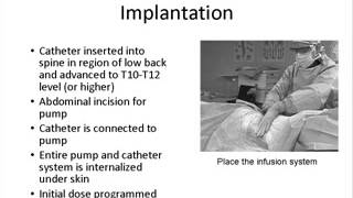 Intrathecal Baclofen Therapy for Spasticity [upl. by Eeneg335]