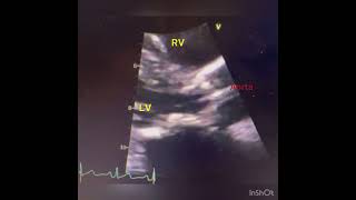 Severe Aortic Stenosis on Echo [upl. by Cale]