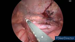 Laparoscopic ureteroureterostomy for mid ureteric obstruction [upl. by Llerrem365]