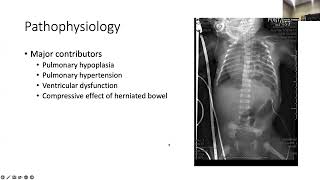 Congenital Diaphragmatic Hernias [upl. by Tallbott]