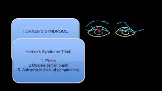 Eye Lid Ptosis [upl. by Ballinger]