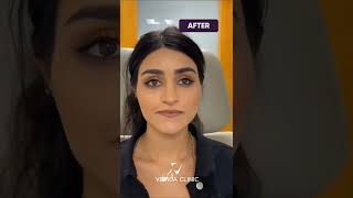 Rhinoplasty Results 1 Week Post operation  Vetica clinic In Turkey [upl. by Sucul234]