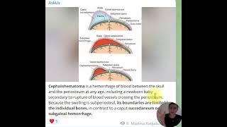 Cephalohematoma caput succedaneum subgaleal hemorrhage [upl. by Akimak]