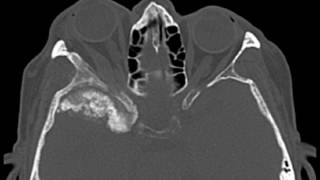 Sphenoid Wing Meningioma [upl. by Arob]