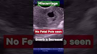 Early Pregnancy Failure ultrasound pregnancy miscarriage abortion [upl. by Merissa715]