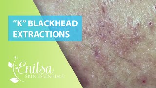 Blackheads Extractions “K’s” 7th Treatment [upl. by Zurek]