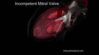 Mitral Valve normal and incompetent [upl. by Danya]