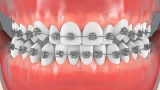 Braces for Crowded Teeth Center View [upl. by Reggi]