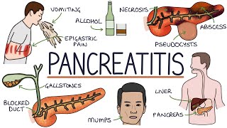 Understanding Pancreatitis [upl. by Riem]