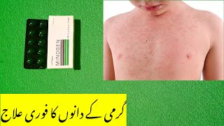 Garmi ke dano ka ilaj  Prickly heat treatment  Heat Rash Treatment  pit ki dawai [upl. by Assereht]