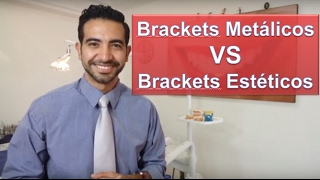 Brackets metálicos o estéticos ¿Cuál es mejorOrtodoncia en Querétaro [upl. by Snook929]