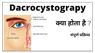 Dacrocystography प्रकिया क्या होती है  और कैसे की जाती है सम्पूर्ण जानकारी [upl. by Hareema199]