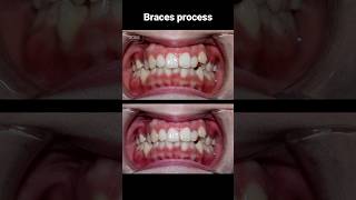 Braces transformation braces orthodontist [upl. by Ailuj321]