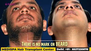 5000 Grafts Hair Transplant Results in grade 6 at Medispa By Dr Suneet Soni [upl. by Aihsemat285]