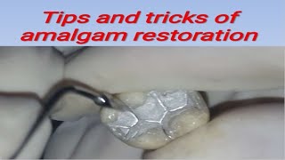 Tips and tricks of Amalgam and Composite restoration [upl. by Galasyn909]