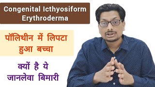 Congenital Icthyosiform Erythroderma  पॉलिथीन में लिपटा हुआ बच्चा  क्यों है ये जानलेवा बिमारी [upl. by Fleisig]