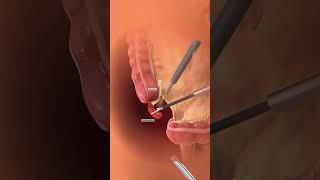 Appendectomy anatomy 3danatomy health [upl. by Anivek]