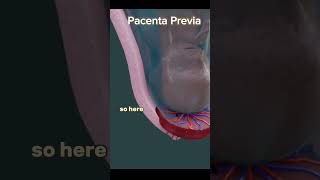 3D Placenta Previa [upl. by Leon]