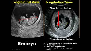 First Trimester amp Ectopic Pregnancy Ultrasound Image Appearances [upl. by Helse840]