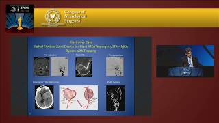 NEUROSURGERY Cerebrovascular Paper of the Year GSS I 2017 CNS Annual Meeting [upl. by Caswell]