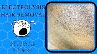 Electrolysis Hair Removal PCOS Facial Hair Trinidad YouTuber [upl. by Thanasi]