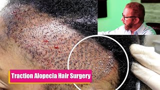 Traction Alopecia Hair Surgery  Black Female Hair Transplants [upl. by Culver595]